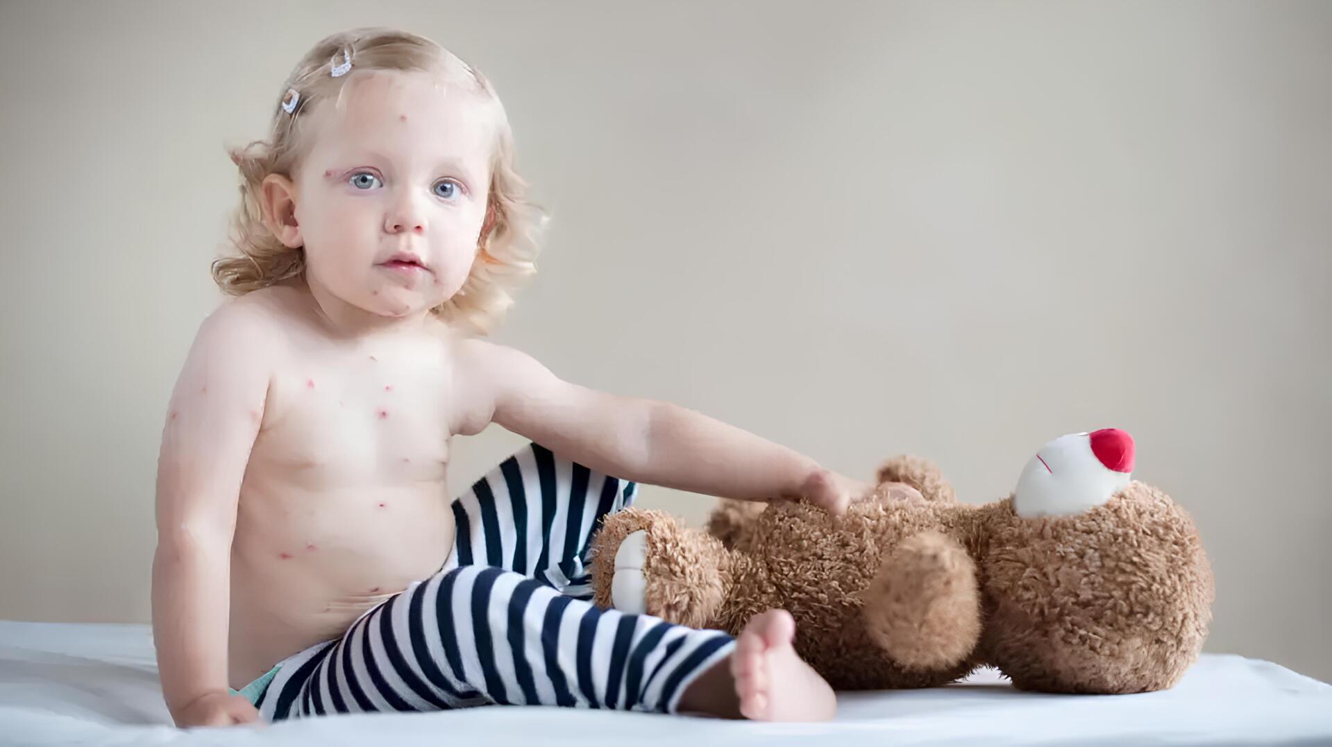 بیماری سرخک در کودکان: علائم، درمان و پیشگیری