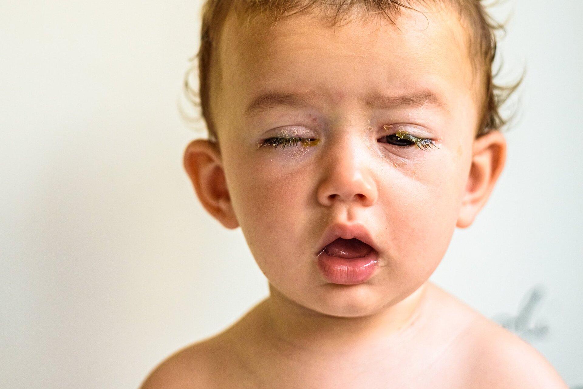 عفونت چشم کودکان در اثر سرماخوردگی: علائم، پیشگیری و درمان