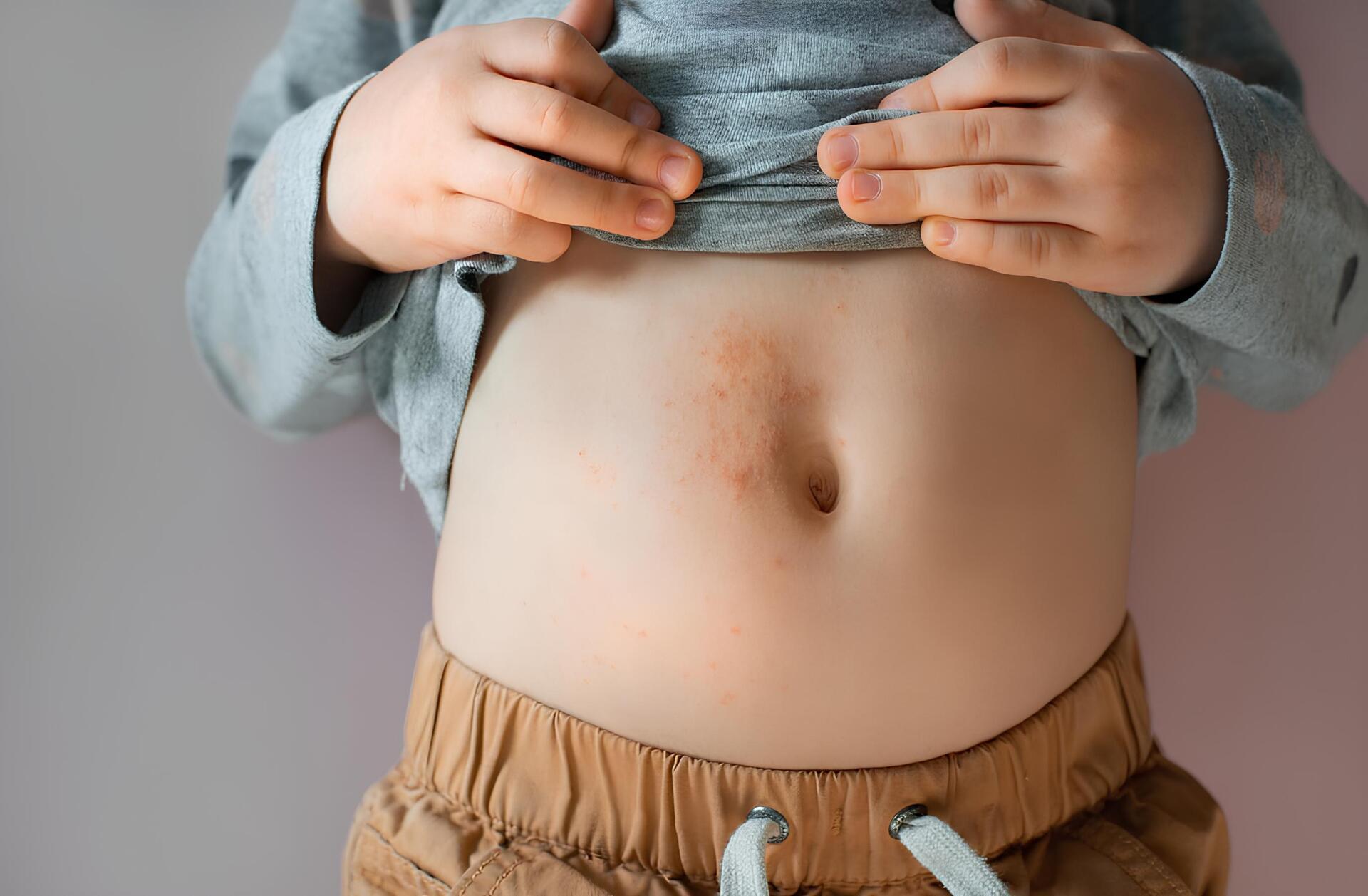 بیماری گال در کودکان: علائم، تصاویر و روش‌ های درمان