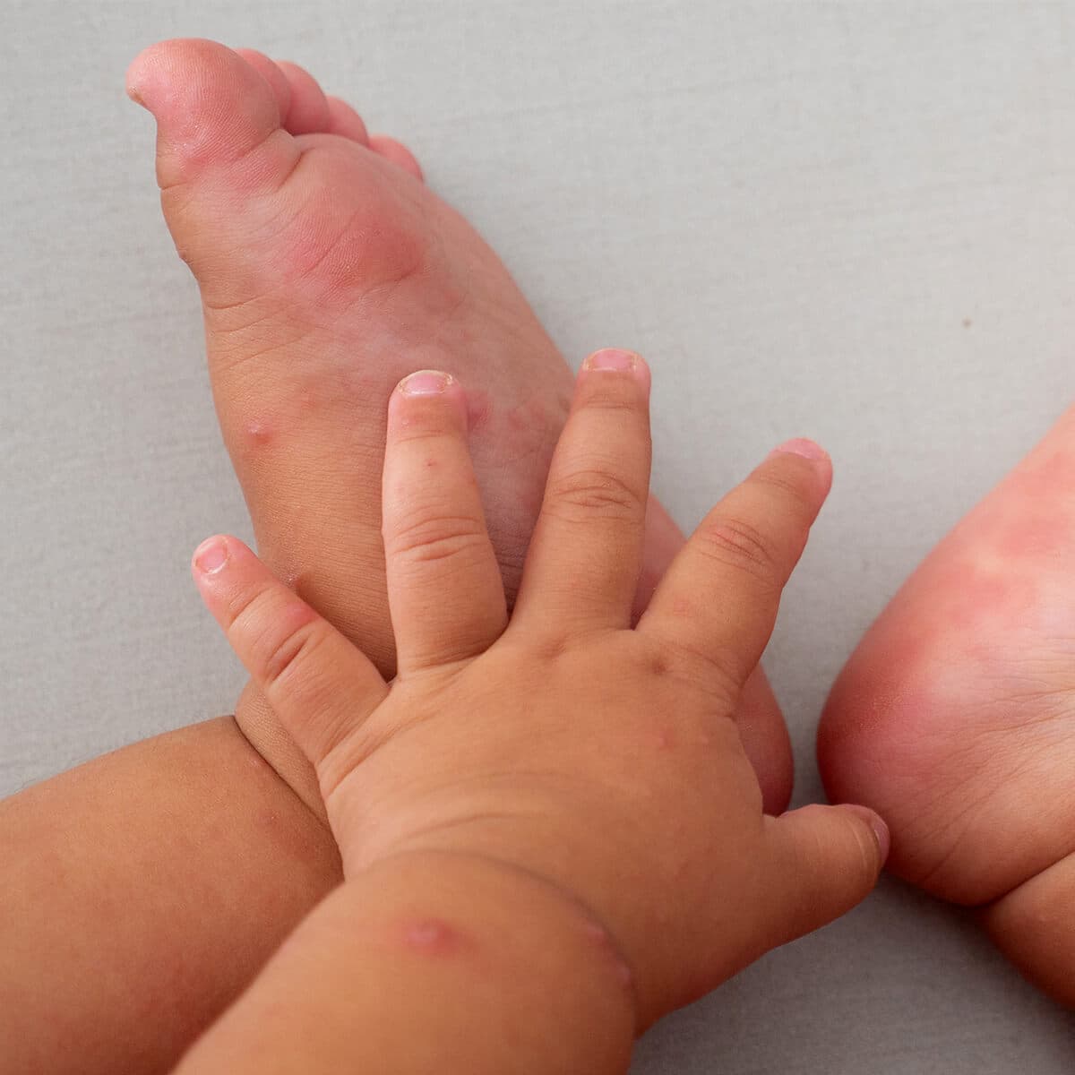 بیماری دست پا دهان در کودکان (HFM)  چیست؟