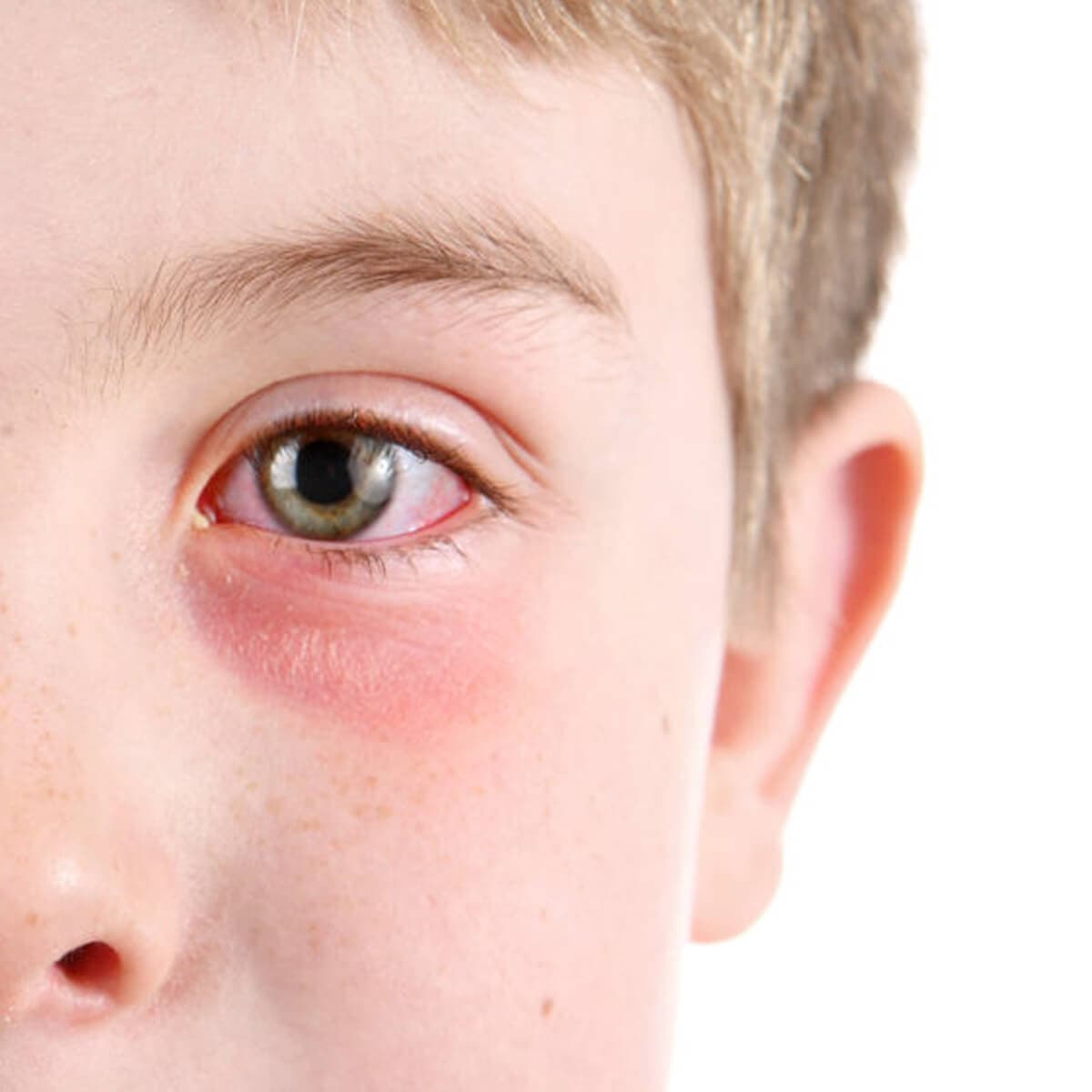 بیماری چشم صورتی در کودکان – علائم ، پیشگیری و درمان